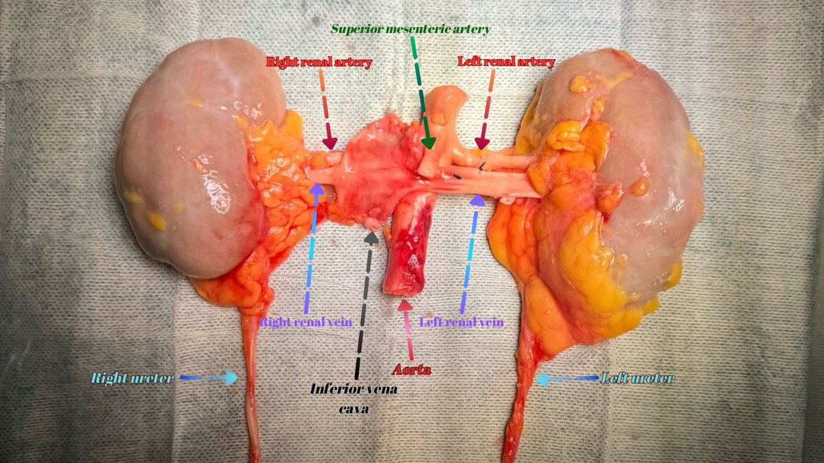 Muhammed Emin Polat (@eminmpolat) on Twitter photo “Kidney procurement using en-bloc technique and meticulous preparation on the bench table for subsequent transplantations. A precise blend of surgical skill and anatomical expertise.”
<a href="/AngeloTerrito/">Angelo Territo</a> <a href="/YAU_Transplant/">EAU-YAU-Kidney Transplant Working Group</a>
#Urology #Kidney #Transplantation “Kidney procurement using en-bloc technique and meticulous preparation on the bench table for subsequent transplantations. A precise blend of surgical skill and anatomical expertise.”
<a href="/AngeloTerrito/">Angelo Territo</a> <a href="/YAU_Transplant/">EAU-YAU-Kidney Transplant Working Group</a>
#Urology #Kidney #Transplantation