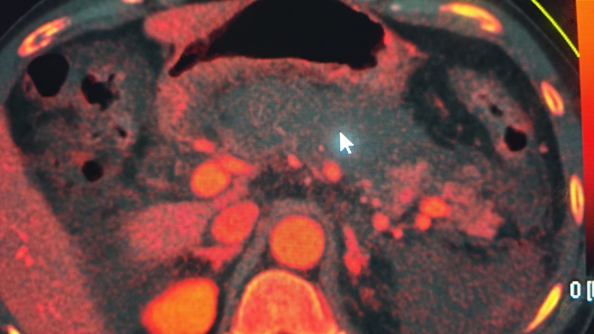 abdo_imaging's tweet photo. @AlcoholChangeUK 
Christmas and New year parties are ON and we are seeing increased Alcohol Related Necrotozing Pancreatitis. 

Image: Pancreatic necrosis (arrow) #dualenergyct

Avoid #binging #highintensitydrinking 

@UK_AHA @goFAAR @AJR_Radiology @AmerGastroAssn @RadiologyACR https://t.co/JVW8LtnWCx