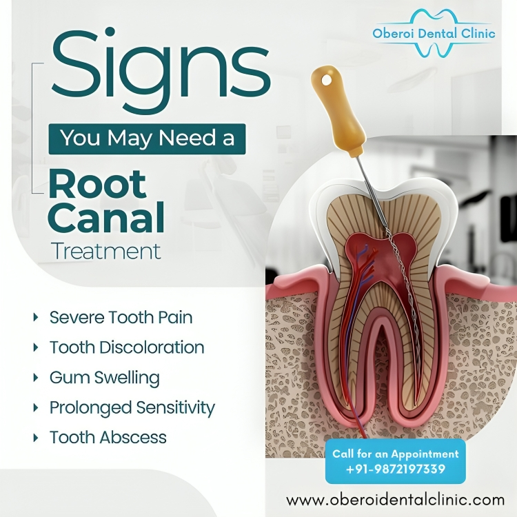 clinic_oberoi's tweet image. Signs You May Need a Root Canal Treatment

* Servere Tooth Pain 
* Tooth Descoloration
* Gum Swelling
* Prolonged Sensitivity
* Tooth Abscess
#RCT  #rootcanaltreatment #oraltreatment #oralhealth 

👨‍⚕️ Dr. Ramandeep Oberoi 📞 +91-9872197339 🌐 oberoidentalclinic.com