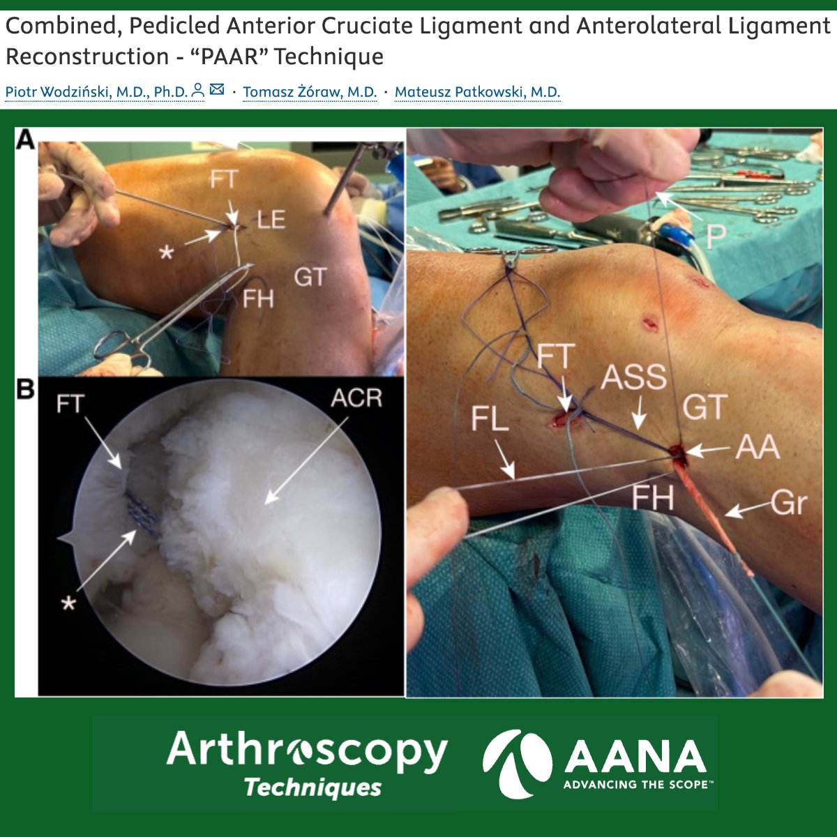 In this Arthroscopy Techniques Technical note, a simple technique of combined #ACL and #ALL reconstruction using pedicled semitendinosus and gracilis tendons with a single femoral tunnel and no additional tibial tunnels is shown #arthroscopy