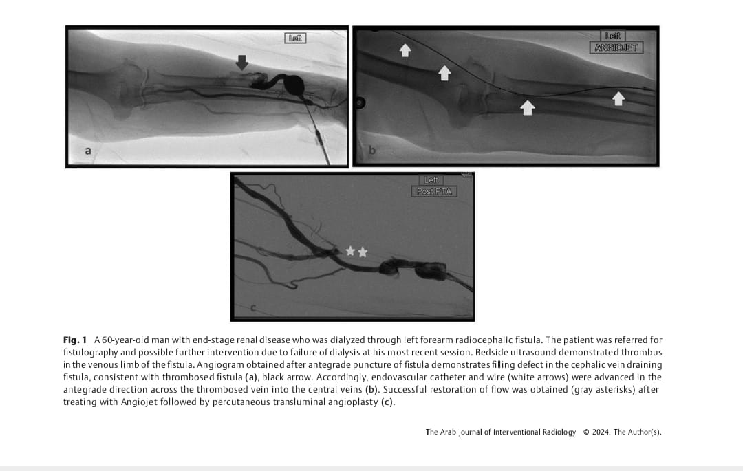 The Arab Journal of Interventional Radiology (@arabjir) on Twitter photo #AJIR Original Article : Rheolytic Pharmacomechanical Thrombectomy in Renal Dialysis Arteriovenous Fistula and Graft Thrombosis: Outcomes from a Tertiary Hospital in Qatar <a href="/pairsmedia/">PAIRS</a>
Abstract: thieme-connect.com/products/ejour…
HTML: thieme-connect.com/products/ejour…
PDF: thieme-connect.com/products/ejour… #AJIR Original Article : Rheolytic Pharmacomechanical Thrombectomy in Renal Dialysis Arteriovenous Fistula and Graft Thrombosis: Outcomes from a Tertiary Hospital in Qatar <a href="/pairsmedia/">PAIRS</a>
Abstract: thieme-connect.com/products/ejour…
HTML: thieme-connect.com/products/ejour…
PDF: thieme-connect.com/products/ejour…