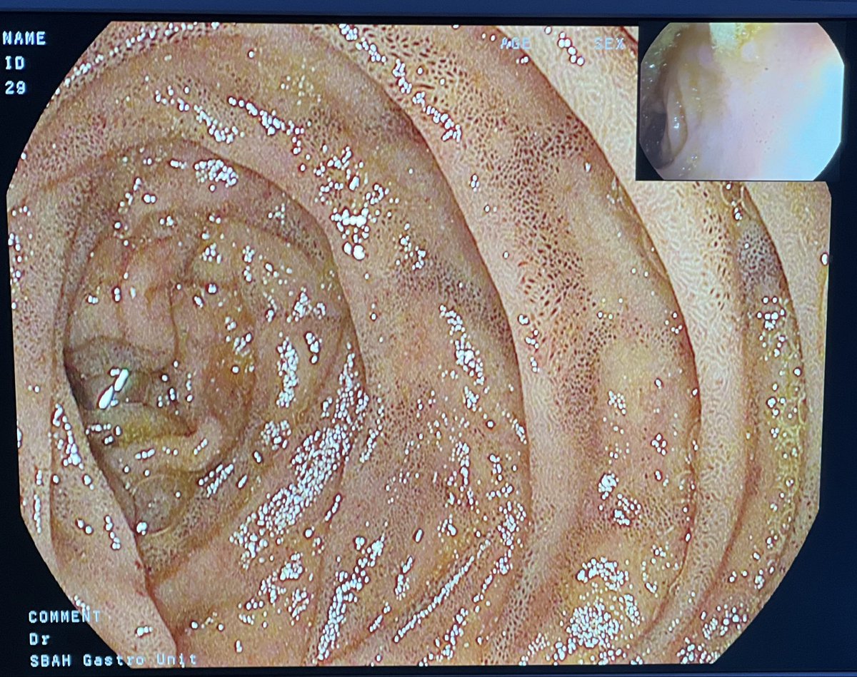 BadreldinY's tweet photo. Pseudonelanosis Duodenai 

A rare condition characterized by dark pigmentation of the duodenal musosa
In this case  , it is due to CKD https://t.co/mdSJiC6Q6S