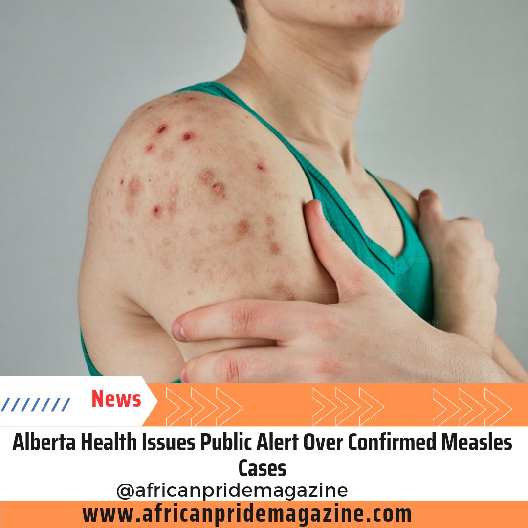 africanpridemag's tweet photo. Alberta Health Issues Public Alert Over Confirmed Measles Cases 

Alberta Health Servi... https://t.co/TFkuhEQazF
#Africanpride #Africanpridemagazine #AfricanPridemagazinefan #Africanprideradio #AfricanPrideTV #albertahealthservices https://t.co/tu6RuaPqRn