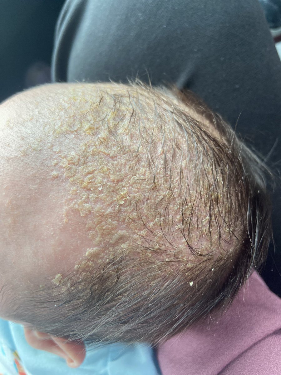 bellakerry_'s tweet photo. Siapa baby dia ada Cradle Cap angkat tangan 🙋🏼‍♀️ https://t.co/0PMpiszFBK