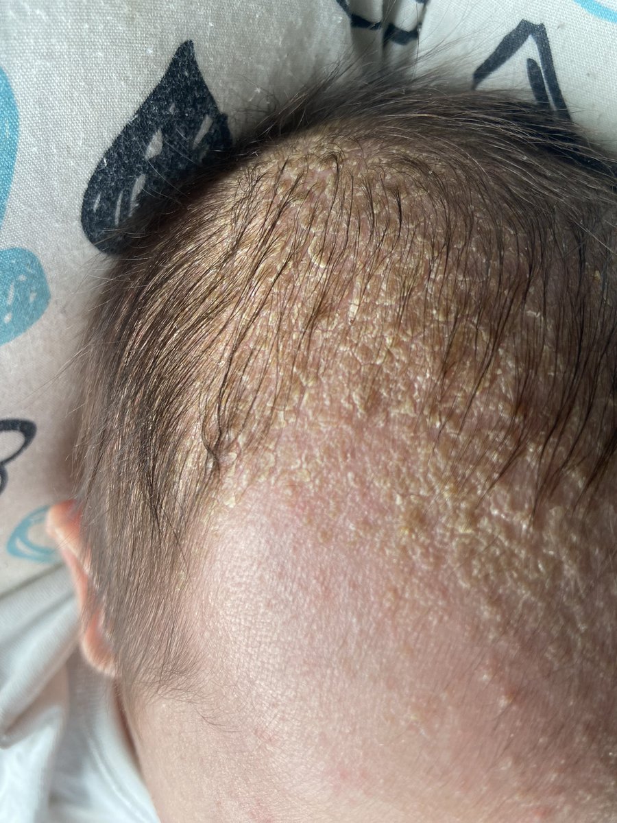 bellakerry_'s tweet photo. Siapa baby dia ada Cradle Cap angkat tangan 🙋🏼‍♀️ https://t.co/0PMpiszFBK