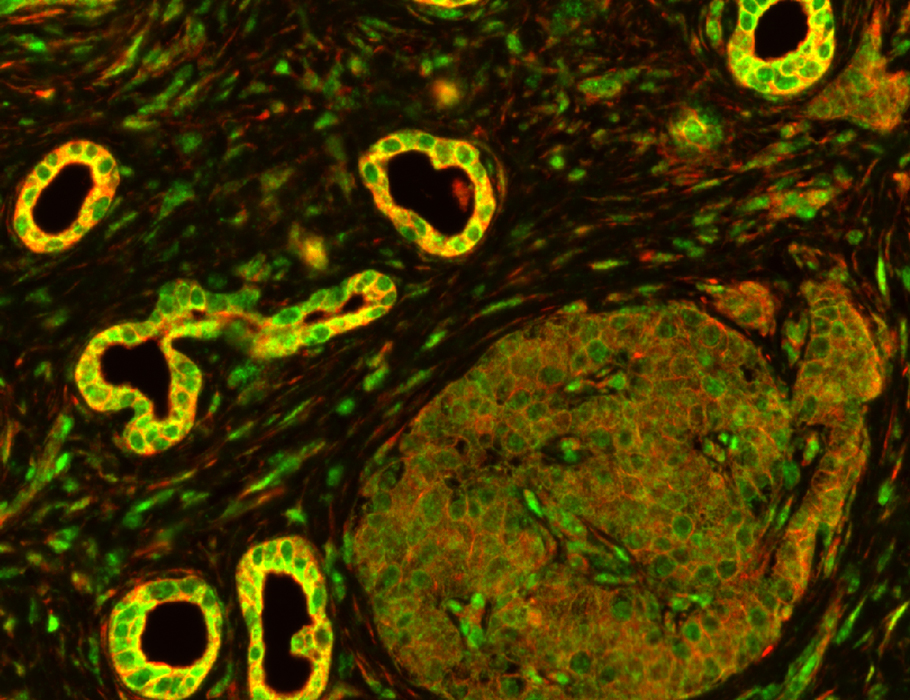 Science Signaling (@scisignal) on Twitter photo Studying the mechanisms of #EpithelialToMesenchymal transition, researchers investigated the kinase AKT and identified a pathway centered on TBK1 required for EMT and metastatic spread in pancreatic cancer in mice. <a href="/UTSWCancerBio/">UTSWCancerBio</a> <a href="/brekkenlab/">Brekkenlab</a> <a href="/enarner/">Emily Baker, Ph.D.</a> scim.ag/41KOxea Studying the mechanisms of #EpithelialToMesenchymal transition, researchers investigated the kinase AKT and identified a pathway centered on TBK1 required for EMT and metastatic spread in pancreatic cancer in mice. <a href="/UTSWCancerBio/">UTSWCancerBio</a> <a href="/brekkenlab/">Brekkenlab</a> <a href="/enarner/">Emily Baker, Ph.D.</a> scim.ag/41KOxea