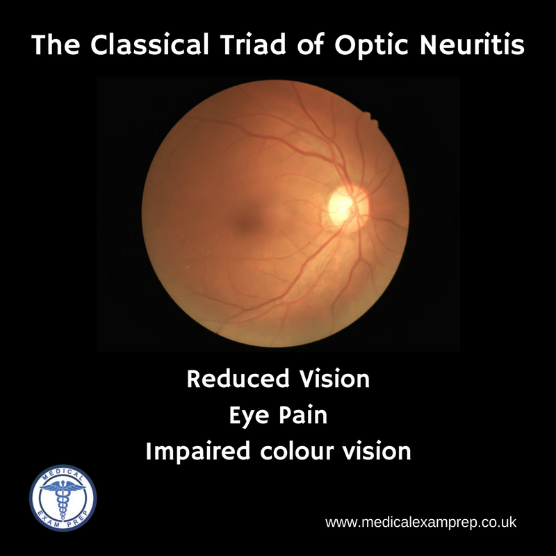 MedicalExamPrep's tweet photo. The classical triad of optic neuritis:
- reduced vision
- eye pain
- impaired colour vision
#FOAMed #MedEd #MRCEM #MRCGP #PLAB https://t.co/AUPokL72ll
