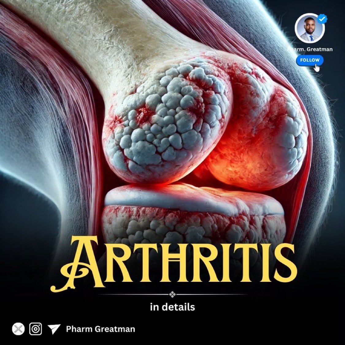 ARTHRITIS 101

Arthritis affects millions globally, bringing pain, stiffness, and swelling to the joints and impacting quality of life.

This is the most comprehensive thread on arthritis, from types and symptoms to causes, treatments, and prevention tips. 

Scroll up to