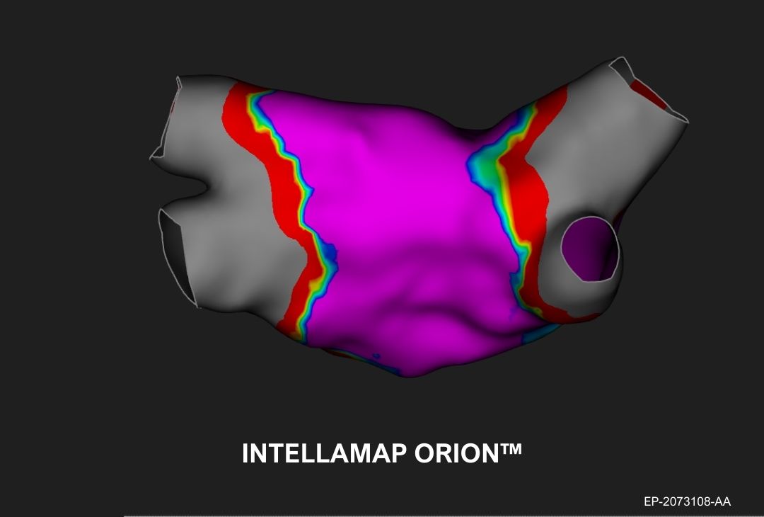 Dr. Jason Meyers and the team from MercyOne in Des Moines, IA gained greater confidence in PFA delivery after seeing the validation map correlation between FARAWAVE NAV™ and an HD catheter on the OPAL HDx™ mapping system.

Case Details:
• Denovo AF patient treated with