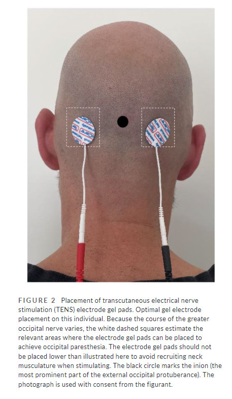 This explorative open-label study suggests transcutaneous electrical nerve stimulation of the #occipital nerves may be an effective preventive treatment for chronic #ClusterHeadache
…adachejournal.onlinelibrary.wiley.com/doi/full/10.11…
<a href="/AnjaSofiePeter2/">Anja Sofie Petersen</a> <a href="/rj_rigmor/">Rigmor H. Jensen</a> <a href="/hedemann_jens/">Jens Christian Hedemann Sørensen</a> et al