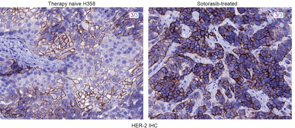 Anirban Maitra (@aiims1742) on Twitter photo New preprint of preclinical data from <a href="/BrunaPellini/">Bruna Pellini, MD</a> <a href="/MoffittNews/">Moffitt Cancer Center</a> on potential combination to overcome KRASi resistance.
Trastuzumab deruxtecan combination strongly enhances responses and overcomes sotorasib resistance in KRASG12C-mutant NSCLC.
Importantly, the Sotorasib-Enhertu New preprint of preclinical data from <a href="/BrunaPellini/">Bruna Pellini, MD</a> <a href="/MoffittNews/">Moffitt Cancer Center</a> on potential combination to overcome KRASi resistance.
Trastuzumab deruxtecan combination strongly enhances responses and overcomes sotorasib resistance in KRASG12C-mutant NSCLC.
Importantly, the Sotorasib-Enhertu