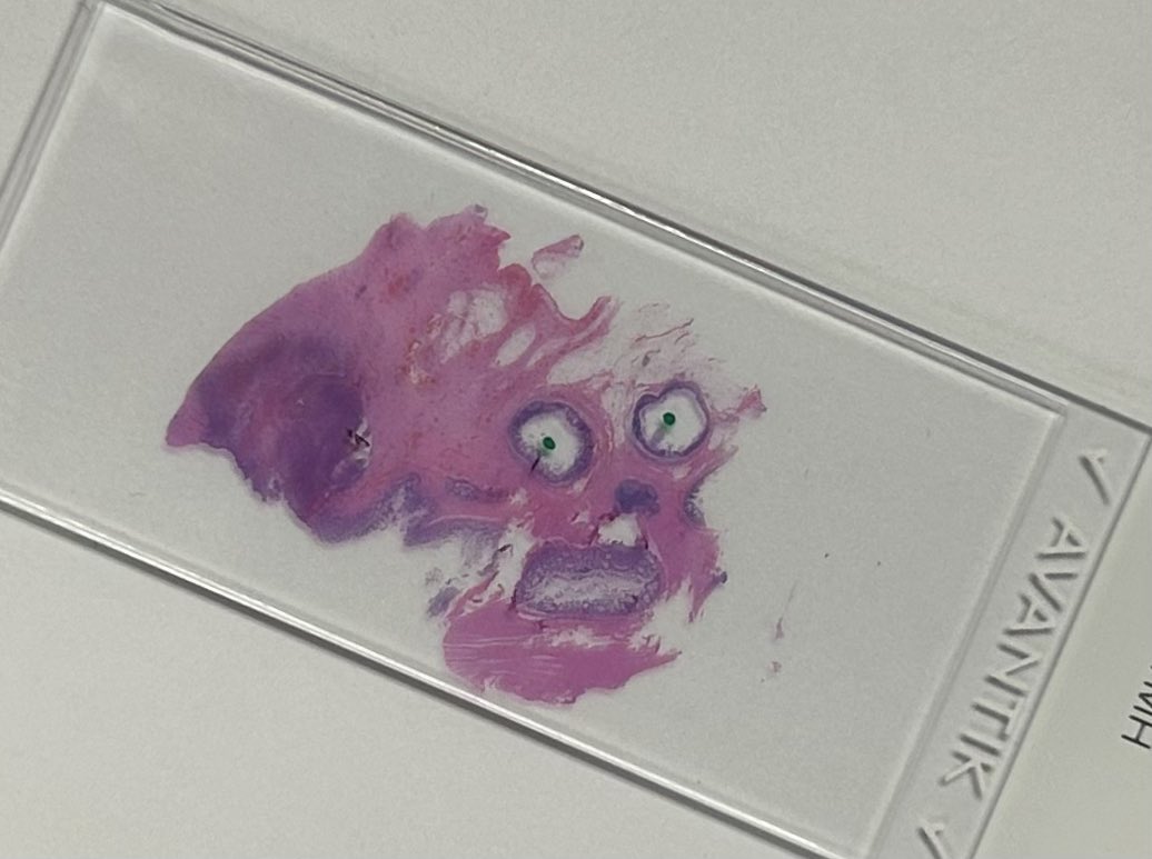 It’s time to go home when the diverticuli start staring back at you