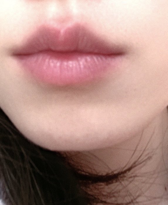 唇珠长了个泡  不用do了