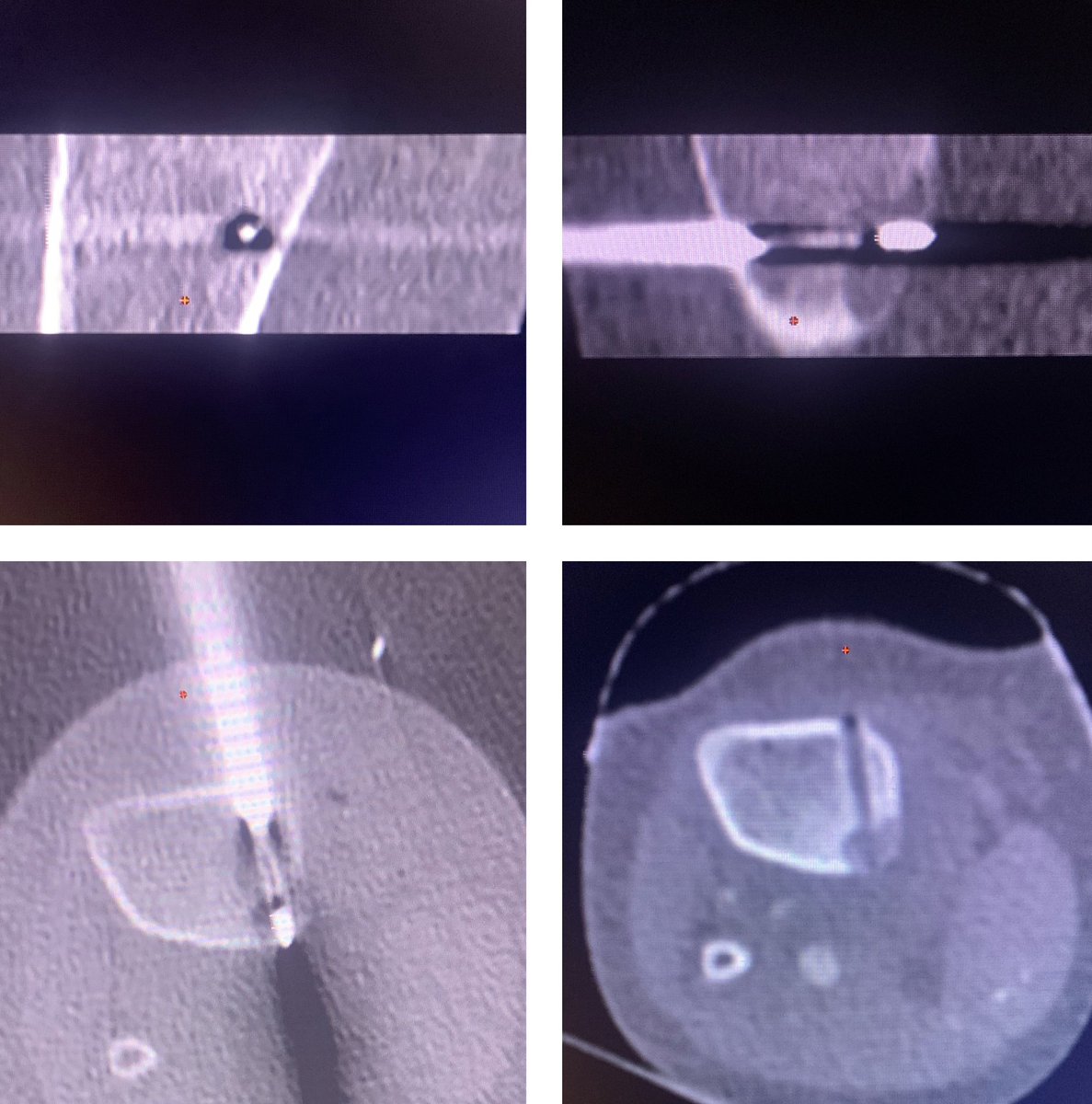 Karan Anandpara (@karananandpara) on Twitter photo Case 98: with <a href="/BhaveshPopat7/">Bhavesh Popat</a> <a href="/rohankhadtare/">Dr Rohan khadtare</a> Dr Vatsal A
.
9Y/M; Osteoid Osteoma; right leg nocturnal pain; relieved by med; CT guided RF Ablation
.
#irad #MedTwitter #MedEd #orthotwitter Case 98: with <a href="/BhaveshPopat7/">Bhavesh Popat</a> <a href="/rohankhadtare/">Dr Rohan khadtare</a> Dr Vatsal A
.
9Y/M; Osteoid Osteoma; right leg nocturnal pain; relieved by med; CT guided RF Ablation
.
#irad #MedTwitter #MedEd #orthotwitter