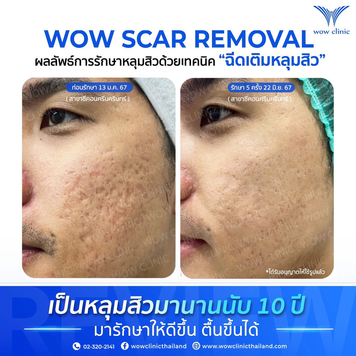 wowclinix's tweet photo. รีวิวจาก “คุณพีท” อายุ 29 ปี อาชีพผู้รับเหมา
หลังการรักษาเพียง 5 ครั้งเท่านั้น✨

#หลุมสิว #ฉีดหลุมสิว #รอยสิว
#รอยดำ #รักษาหลุมสิว
#wowclinic 
#หลุมสิว #ฉีดหลุมสิว https://t.co/94m7FRpEW5