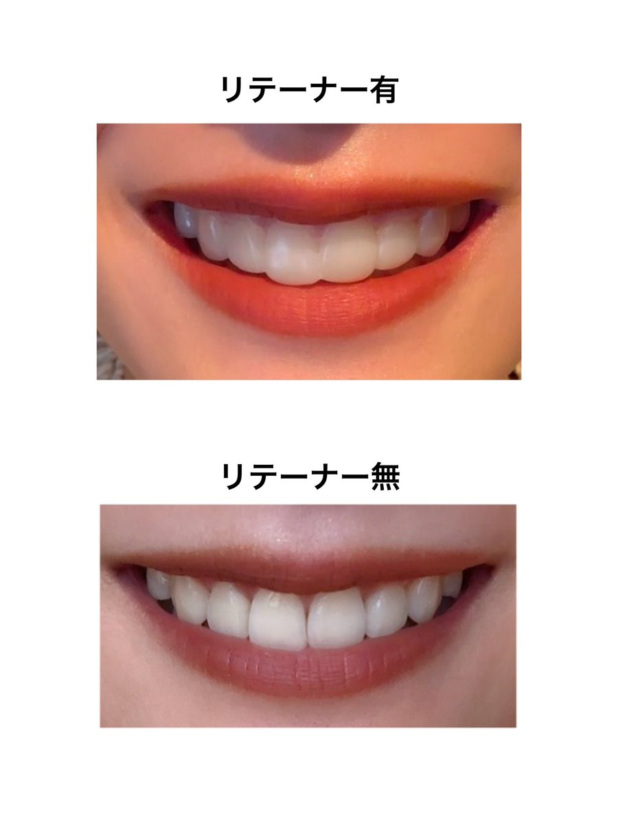 ah__s2's tweet photo. ブラオフ前日はシュウ ウエムラごっこをやりました🦷💄(わかる人にはわかるやつ)

リテーナーは最初の1週間は滑舌が気になりましたが、2週目くらいからは普通に話せるようになりました🥺

好きなものを気にせずに食べられて幸せです🤤❤️‍🔥❤️‍🔥

#歯列矯正
#矯正日記 https://t.co/iP3xcox68U