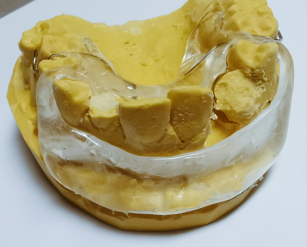 Today's case is splint made with Labial shell

For Vestibuloplasty procedure

C clasps are placed on the molars and acrylic attachment on the occlusal surface to connect the labial portion

The labial trimming is marked according to the Dr's instructions