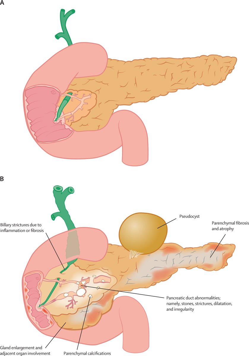 TheLancet's tweet photo. Chronic pancreatitis is a progressive fibroinflammatory disease primarily caused by a complex interplay of environmental &amp; genetic risk factors.

A Seminar summarises current evidence on chronic pancreatitis, &amp; discusses key areas for future research: https://t.co/4nXakinVoI https://t.co/G76ojY1dmm