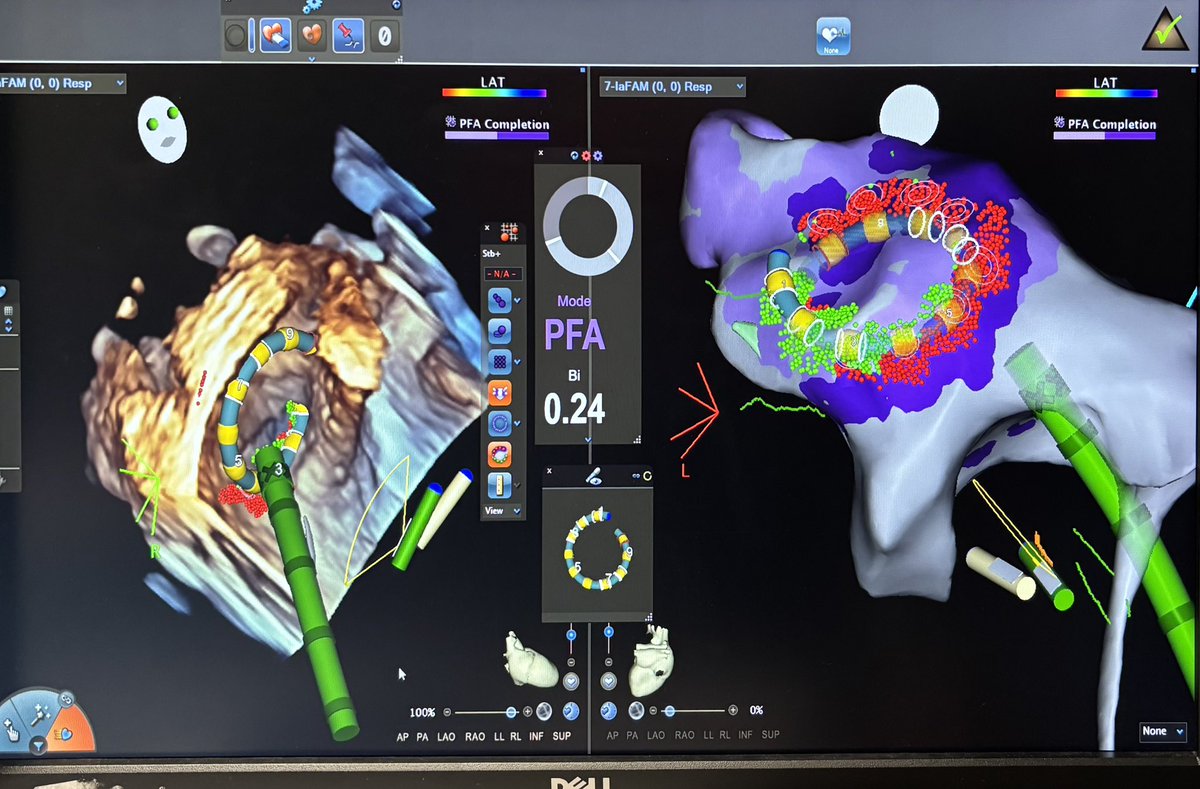 Dr. Devi G Nair (@drdevignair) on Twitter photo It’s been an exciting week in the <a href="/StBernards/">St. Bernards Healthcare</a> EP lab! We had the privilege of using the NUVISION Nav catheter during a Varipulse PFA procedure, combining streamlined workflow integration with the advanced capabilities of 4D imaging. The 4D Freezebank feature provided unparalleled It’s been an exciting week in the <a href="/StBernards/">St. Bernards Healthcare</a> EP lab! We had the privilege of using the NUVISION Nav catheter during a Varipulse PFA procedure, combining streamlined workflow integration with the advanced capabilities of 4D imaging. The 4D Freezebank feature provided unparalleled