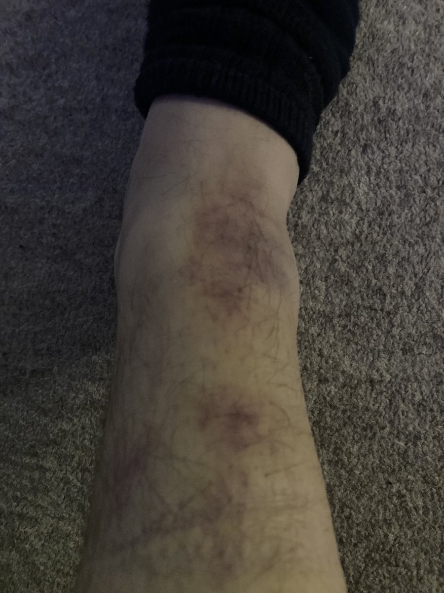 Phil_Daniels's tweet image. Yes I might be too old to still be playing football. Pace has gone but technically it’s still there and you become aware of how to avoid heavy challenges. However you’re never quite ready for fuckwit teammates whose lack of ability &amp;amp; control takes you out too! 🤣