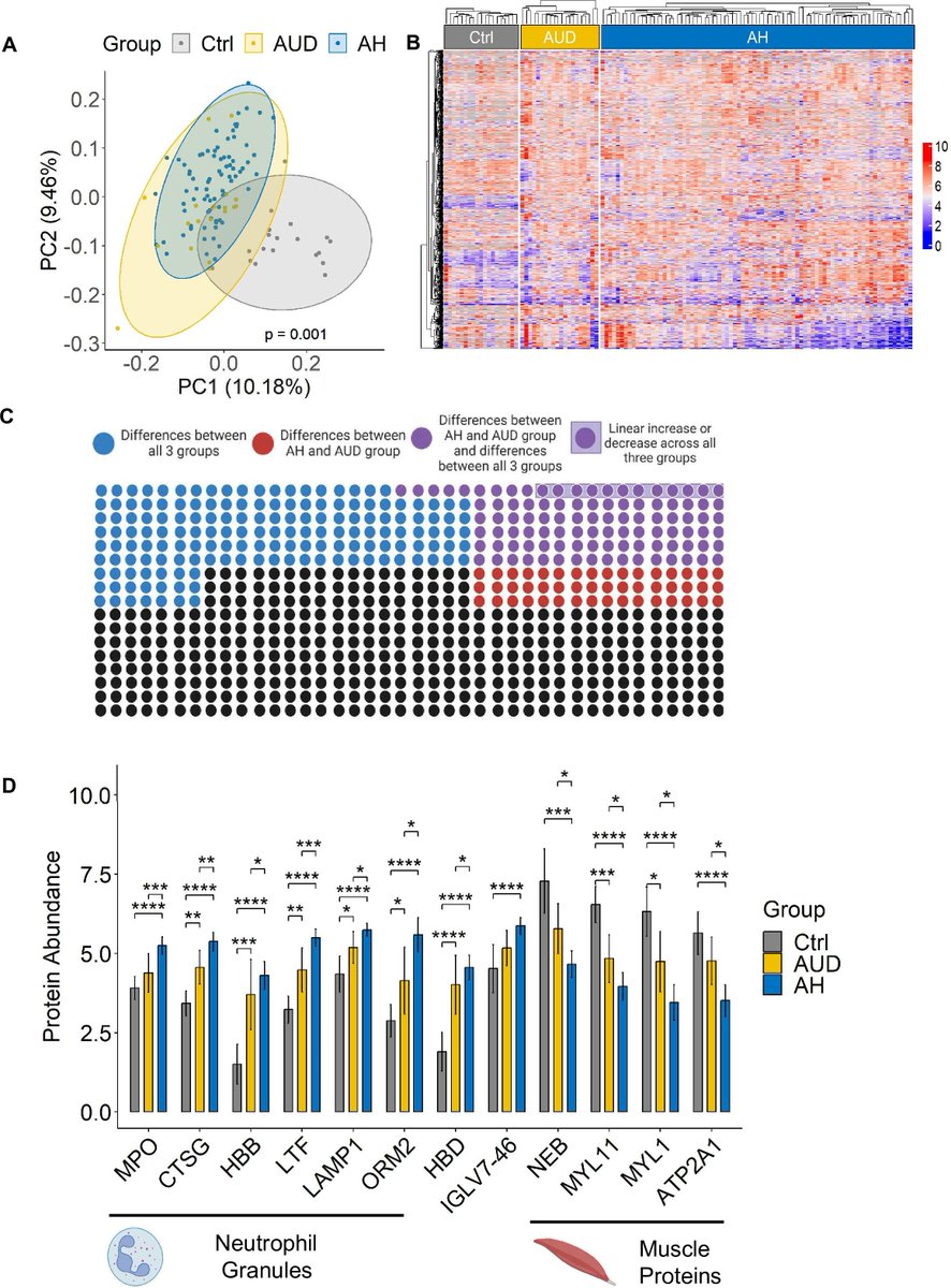 Gut Journal (@gut_bmj) on Twitter photo #GUTImage from the paper by Henriette Kreimeyer et al entitled
"Faecal proteomics links neutrophil degranulation with mortality in patients with alcohol-associated hepatitis" via
bit.ly/41zQSIY
<a href="/DebbieShawcros1/">Debbie Shawcross</a> <a href="/Bernd_Schnabl/">Bernd Schnabl</a> <a href="/SDDRC/">San Diego Digestive Diseases Research Center</a> <a href="/UCSD_GI/">UCSD Gastroenterology</a> #Proteomics #Alcohol #GUTImage from the paper by Henriette Kreimeyer et al entitled
"Faecal proteomics links neutrophil degranulation with mortality in patients with alcohol-associated hepatitis" via
bit.ly/41zQSIY
<a href="/DebbieShawcros1/">Debbie Shawcross</a> <a href="/Bernd_Schnabl/">Bernd Schnabl</a> <a href="/SDDRC/">San Diego Digestive Diseases Research Center</a> <a href="/UCSD_GI/">UCSD Gastroenterology</a> #Proteomics #Alcohol