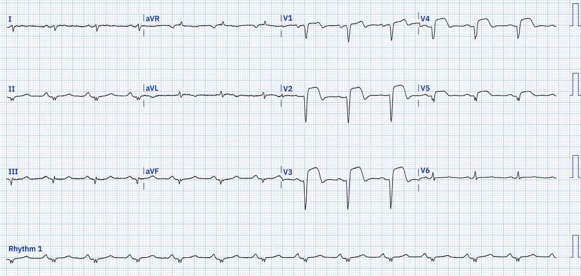 🫀EcgOxford (@ecgoxford) on Twitter photo 56M w CP started 2 days ago but refused to come from day 0.
does the ECG confirm this?
<a href="/akneton/">Ramon Escalona</a> <a href="/yolyabreuh/">Yolanda Abreu H.</a> <a href="/UlhasDr/">Dr Ulhas Pandurangi</a> <a href="/DidlakeDW/">David Didlake</a>
<a href="/ecgrhythms/">Arnel Carmona</a> <a href="/IhabFathiSulima/">Dr Ihab Suliman</a> <a href="/DrPharmDMDTh/">TA✨</a> <a href="/Vadeboncoeur_Al/">Doc Vadeboncoeur</a> <a href="/smithECGBlog/">Stephen W. Smith</a> <a href="/EM_RESUS/">Sam Ghali, M.D.</a> <a href="/OrlandoRPN/">Orlando R. Pérez-Nieto</a> <a href="/fxgodzeuss/">Dr.YusukeKaneko</a> <a href="/TrRja/">Dr.F@心電's合格塾</a> <a href="/NaokiThukishima/">N. Tsukishima EP大学心電図検定学部試験対策科担任</a> <a href="/ecgandrhythmRoe/">Dr. Andreas Roeschl</a> 56M w CP started 2 days ago but refused to come from day 0.
does the ECG confirm this?
<a href="/akneton/">Ramon Escalona</a> <a href="/yolyabreuh/">Yolanda Abreu H.</a> <a href="/UlhasDr/">Dr Ulhas Pandurangi</a> <a href="/DidlakeDW/">David Didlake</a>
<a href="/ecgrhythms/">Arnel Carmona</a> <a href="/IhabFathiSulima/">Dr Ihab Suliman</a> <a href="/DrPharmDMDTh/">TA✨</a> <a href="/Vadeboncoeur_Al/">Doc Vadeboncoeur</a> <a href="/smithECGBlog/">Stephen W. Smith</a> <a href="/EM_RESUS/">Sam Ghali, M.D.</a> <a href="/OrlandoRPN/">Orlando R. Pérez-Nieto</a> <a href="/fxgodzeuss/">Dr.YusukeKaneko</a> <a href="/TrRja/">Dr.F@心電's合格塾</a> <a href="/NaokiThukishima/">N. Tsukishima EP大学心電図検定学部試験対策科担任</a> <a href="/ecgandrhythmRoe/">Dr. Andreas Roeschl</a>