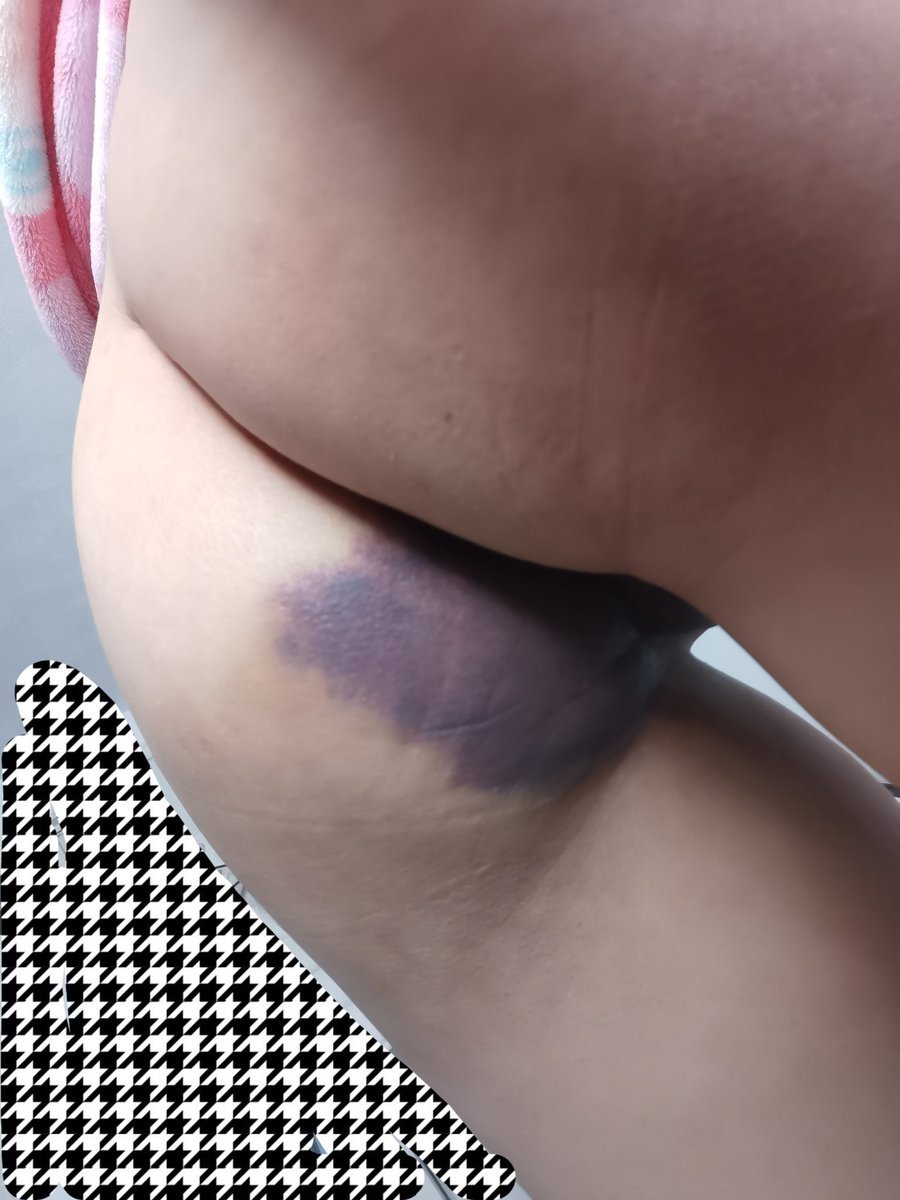 传下去，我是重度贝🙂
被雪场揍了🙂
#重度 #sm #spank #小圈 #单板