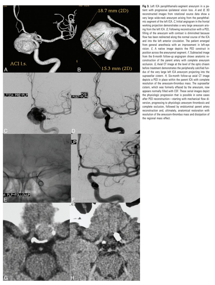 "The Pipeline Embolization Device for the Intracranial Treatment of Aneurysms Trial"

doi.org/10.3174/ajnr.4…