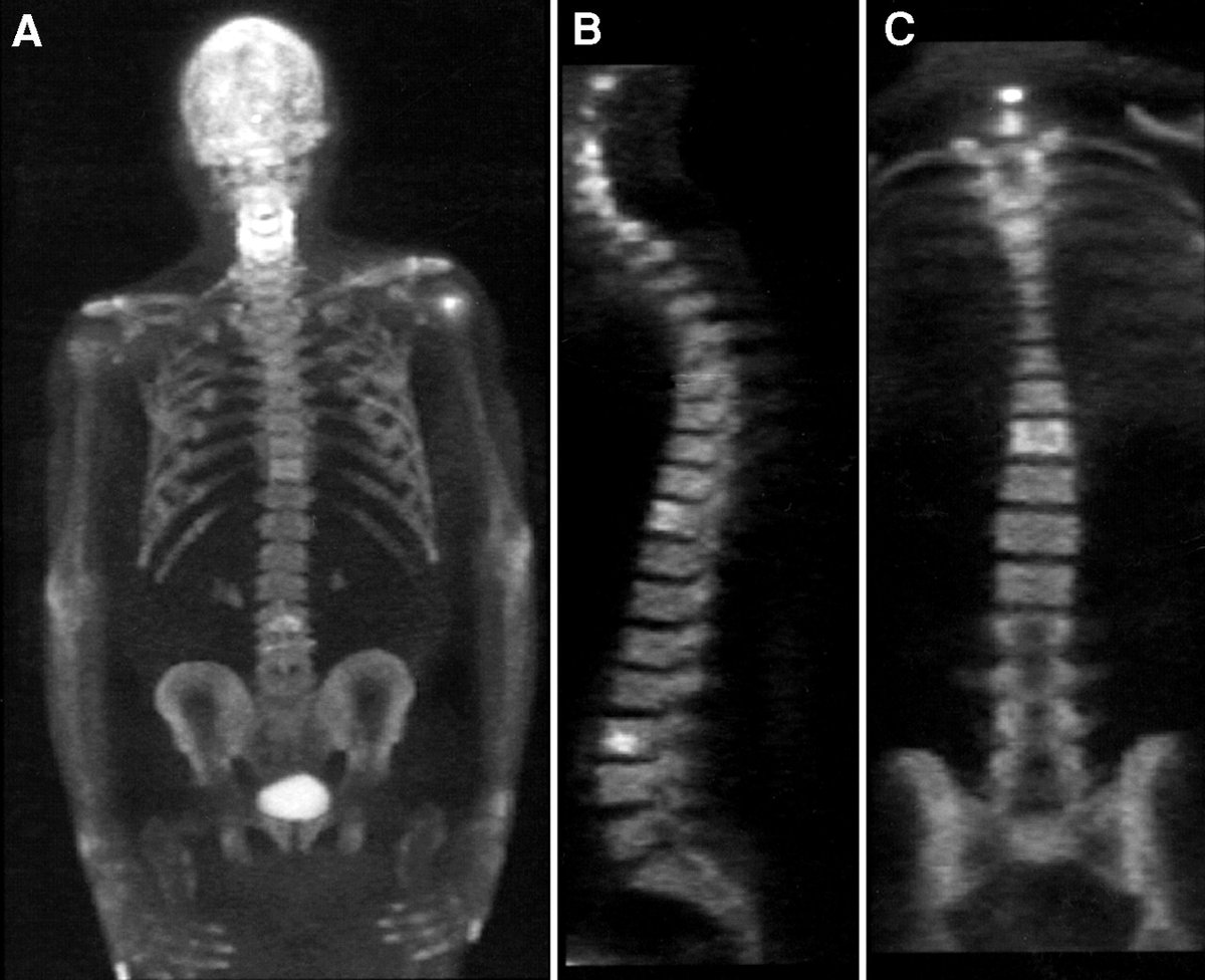 PuriTanuj's tweet photo. [18F]NaF PET is more accurate for detecting bone spread than planar bone scans or SPECT #18FNaF #nucmed #molrad #nuclearmedicine #nuclearradiology #molecularimaging #petct #precisionmedicine #precisionimaging #BoneResearch #ImagingInnovation #BoneImaging
https://t.co/EX9NWd9mDS https://t.co/CxGrO0s0kt