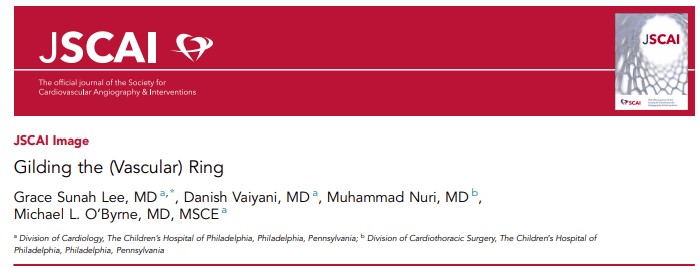 MyJSCAI (@myjscai) on Twitter photo 📚A neonate was born w CHARGE syndrome, giant omphalocele, double outlet right ventricle w subaortic VSD and severe pulmonic stenosis & a vascular ring underwent successful #PDA stenting w 2 telescoped #DES. #PDAstent #CHD
➡️doi.org/10.1016/j.jsca…
<a href="/DanishVaiyani/">Danish Vaiyani</a> <a href="/obyrne_md/">Michael O'Byrne</a> 📚A neonate was born w CHARGE syndrome, giant omphalocele, double outlet right ventricle w subaortic VSD and severe pulmonic stenosis & a vascular ring underwent successful #PDA stenting w 2 telescoped #DES. #PDAstent #CHD
➡️doi.org/10.1016/j.jsca…
<a href="/DanishVaiyani/">Danish Vaiyani</a> <a href="/obyrne_md/">Michael O'Byrne</a>
