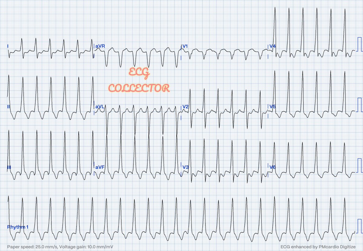 71 y.o.male; DM and HTN; Sepsis secondary to CAP; VS stable;

What is the #ecg rhythm❓🤔

<a href="/PMcardioApp/">PMcardio—AI that reads ECGs</a> 
#CardioEd 
#Cardiology 
#cardiotwitter 
#Medicalstudent 
#MedTwitter