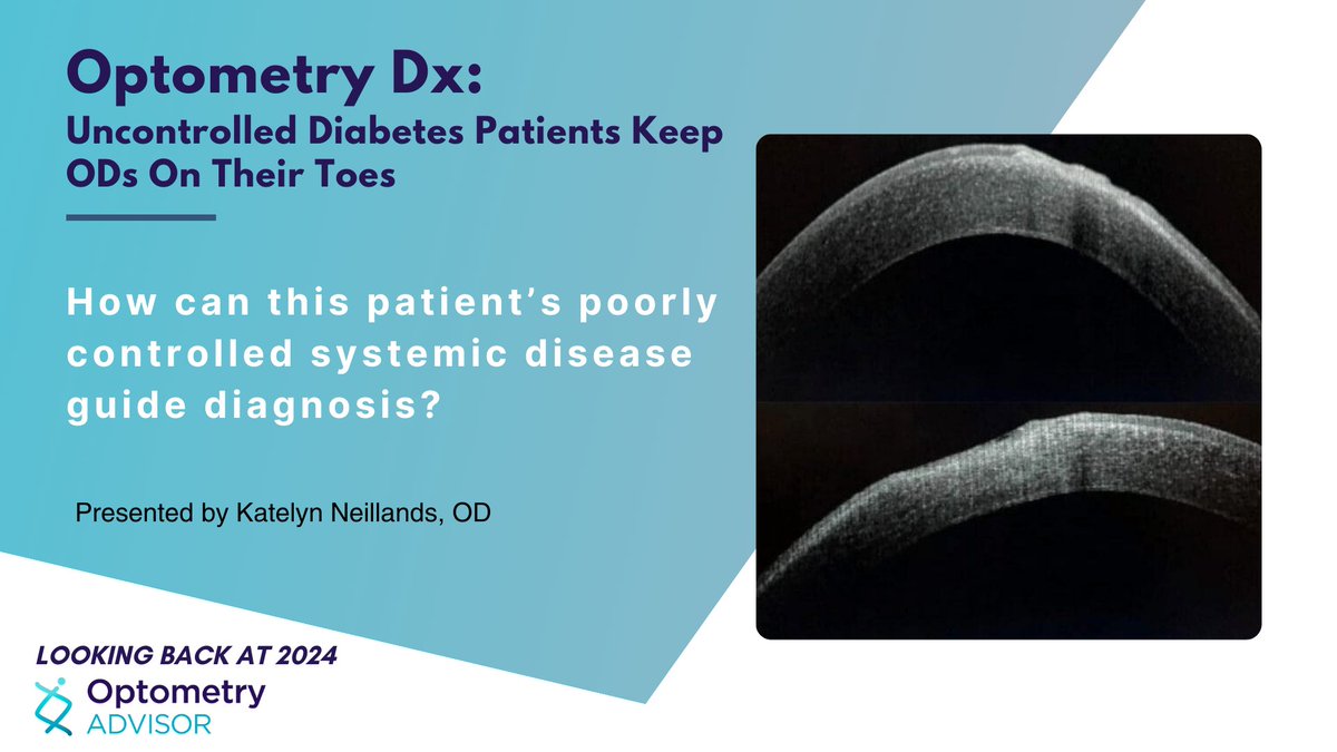 opto_advisor's tweet image. Optometry Dx: Uncontrolled Diabetes Patients Keep ODs On Their Toes

Presented by Katelyn Neillands, OD

How can this patient’s poorly controlled #SystemicDisease guide diagnosis?

Find out here ➡️: bit.ly/49wFUG6

#Diabetes #Optometry #OptometryDx #OD #MedTwitter