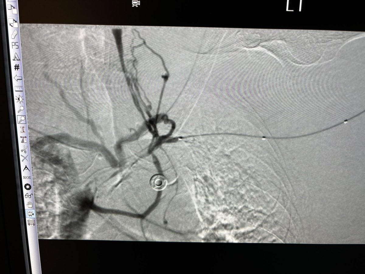 RepkoMd's tweet photo. Went ahead and revascularized central veins. Flow through peripheral cephalic vein 500 cc/min &amp; palpable. https://t.co/EUb2hHZUHq