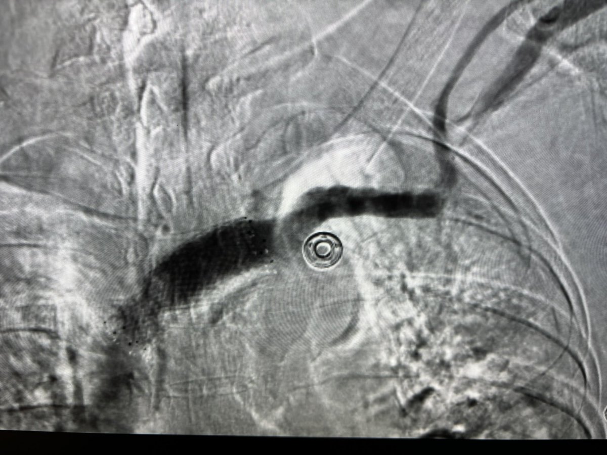 RepkoMd's tweet photo. Went ahead and revascularized central veins. Flow through peripheral cephalic vein 500 cc/min &amp; palpable. https://t.co/EUb2hHZUHq