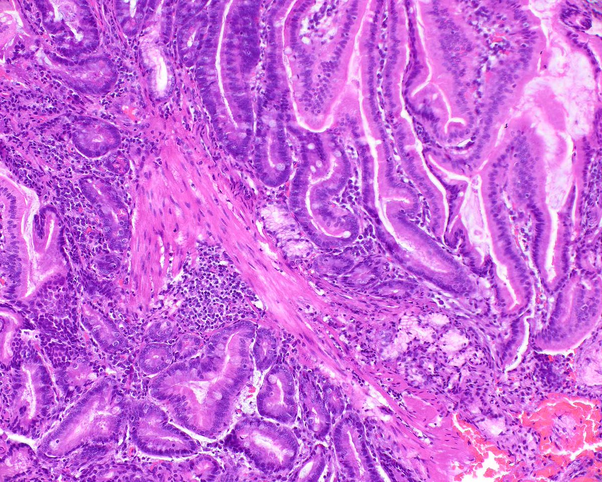This classic Peutz-Jeghers polyp of the duodenum shows cords of smooth muscle that partition off zones of site specific mucosa.  Detecting even a single such polyp can indicate that a patient has this cancer syndrome.
PMID: 17667545.