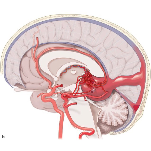 evanluthermd's tweet image. Congenital brain AV shunts can cause problems for the infant during and after pregnancy. Intrauterine embolization can reverse many of the issues resulting in normal child development. Grateful for the progress in our field! #veinofgalen #avm #neuro #endovascular #fetalsurgery
