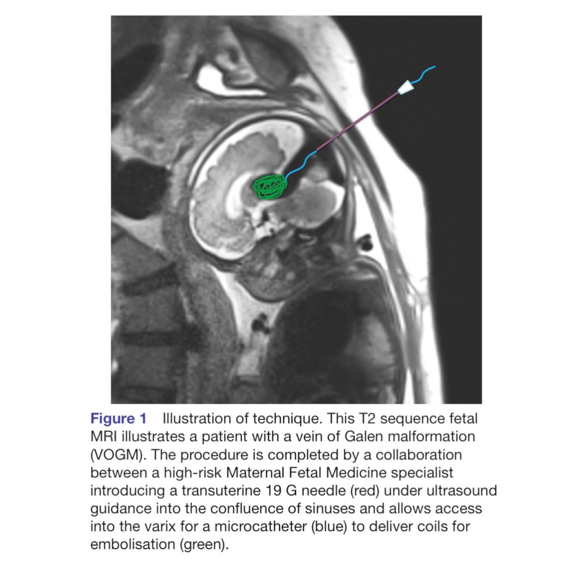 evanluthermd's tweet image. Congenital brain AV shunts can cause problems for the infant during and after pregnancy. Intrauterine embolization can reverse many of the issues resulting in normal child development. Grateful for the progress in our field! #veinofgalen #avm #neuro #endovascular #fetalsurgery