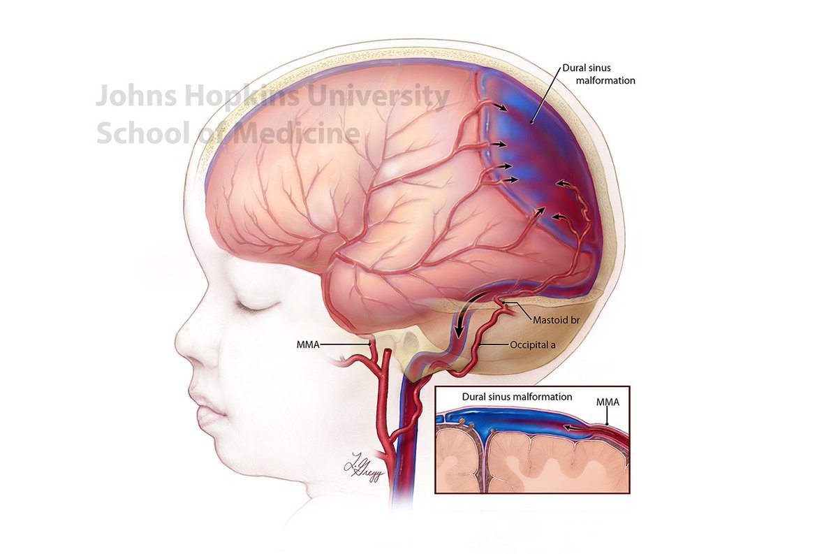 evanluthermd's tweet image. Congenital brain AV shunts can cause problems for the infant during and after pregnancy. Intrauterine embolization can reverse many of the issues resulting in normal child development. Grateful for the progress in our field! #veinofgalen #avm #neuro #endovascular #fetalsurgery