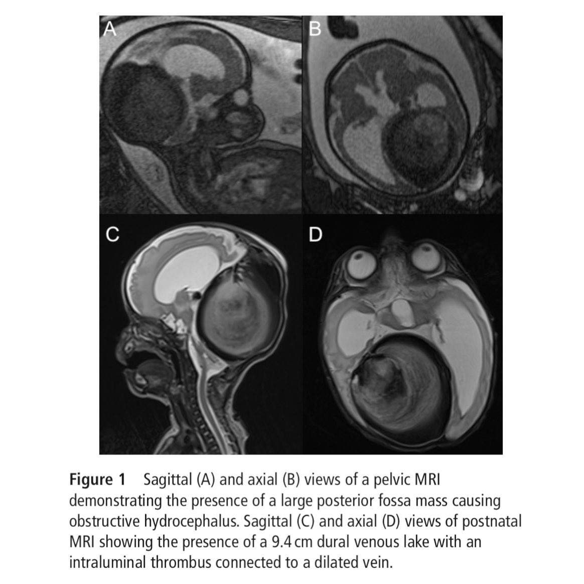 Congenital brain AV shunts can cause problems for the infant during and after pregnancy. Intrauterine embolization can reverse many of the issues resulting in normal child development. Grateful for the progress in our field! #veinofgalen #avm #neuro #endovascular #fetalsurgery