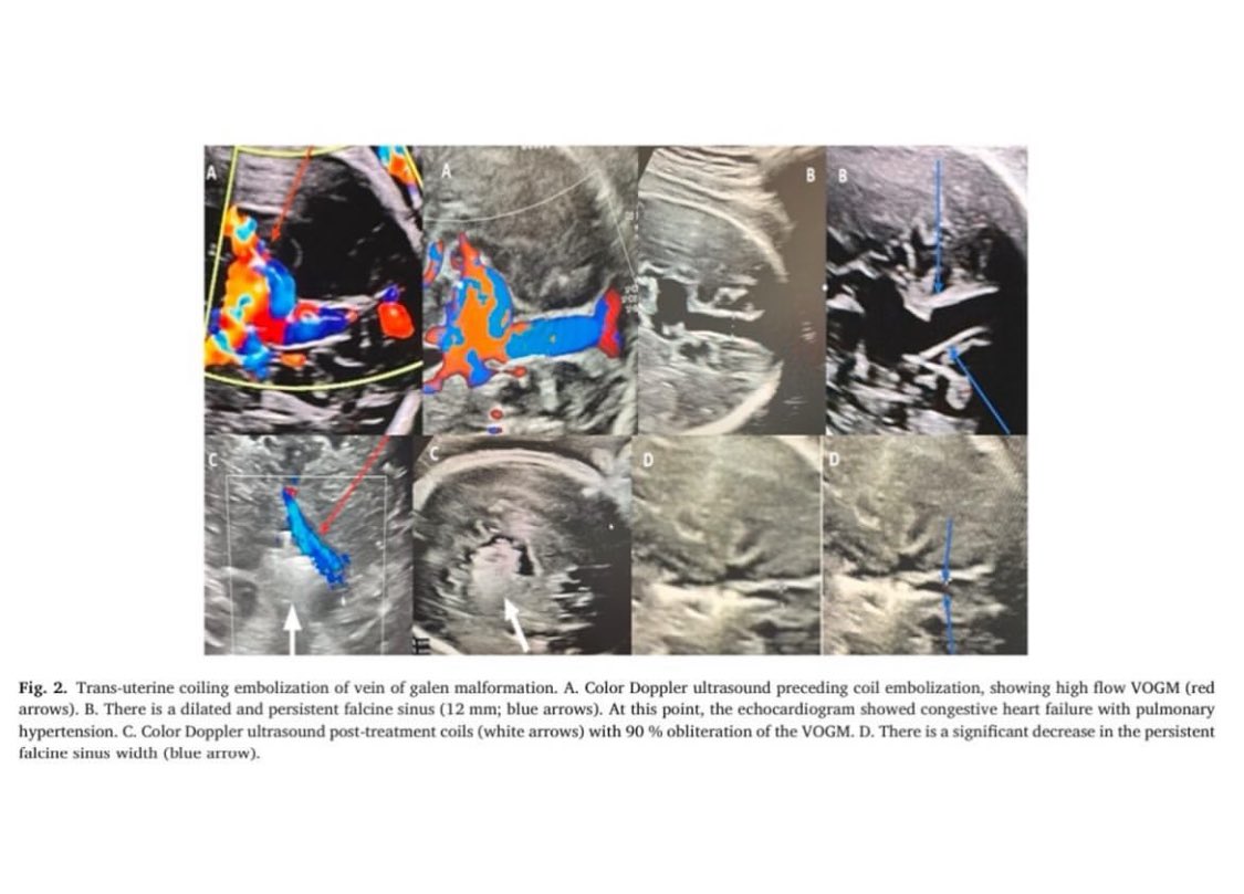 Thrilled to be a shared first author on this technical report, detailing the 4th case of in-utero coiling embolization of VOGM. This innovative work, achieved through the amazing interdisciplinary team at the University of Miami—neurosurgeons, fetal surgeons, OB-GYNs, pediatric