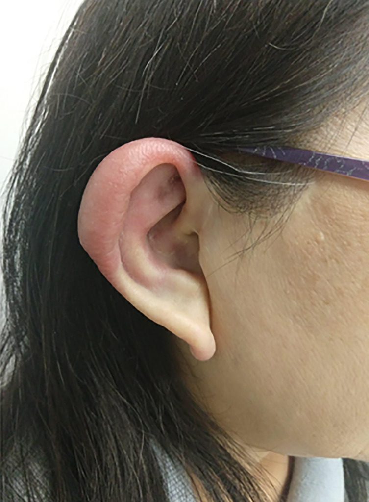 Annals of Internal Medicine: Clinical Cases (@annalsofimcc) on Twitter photo Researchers from <a href="/UCIrvineHealth/">UCI Health</a> discuss a patient w/ ear inflammation that turned out to be a rare disease called relapsing polychondritis, which they found was linked to an underlying cancer lymphoplasmacytic lymphoma, or Waldenström macroglobulinemia
bit.ly/4gQqNtz. Researchers from <a href="/UCIrvineHealth/">UCI Health</a> discuss a patient w/ ear inflammation that turned out to be a rare disease called relapsing polychondritis, which they found was linked to an underlying cancer lymphoplasmacytic lymphoma, or Waldenström macroglobulinemia
bit.ly/4gQqNtz.