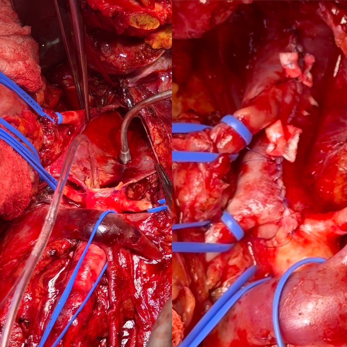 Not an everyday vascular procedure . Coral reef aorta with mesenteric ischemia . Treated with an aortic and visceral arterial endarterectomy.