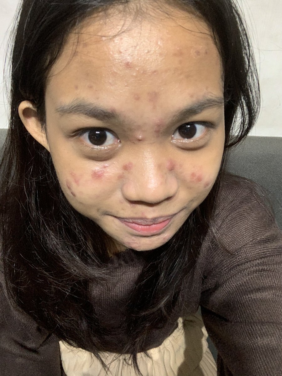 itsayeay's tweet photo. mau sharing ⚠️ acne journey &amp; honest review product yg ku pakai

‼️no endorse &amp; not affiliate ❌

skin type > oily MAMPUS acne prone, kusam😵‍💫

before juni 2024 &amp; after desember 2024 

(HAMPIR semua foto di thread ini aku pakai makeup yah tp bukan yang fresh, udah oksidasi) https://t.co/UScePpnfBj