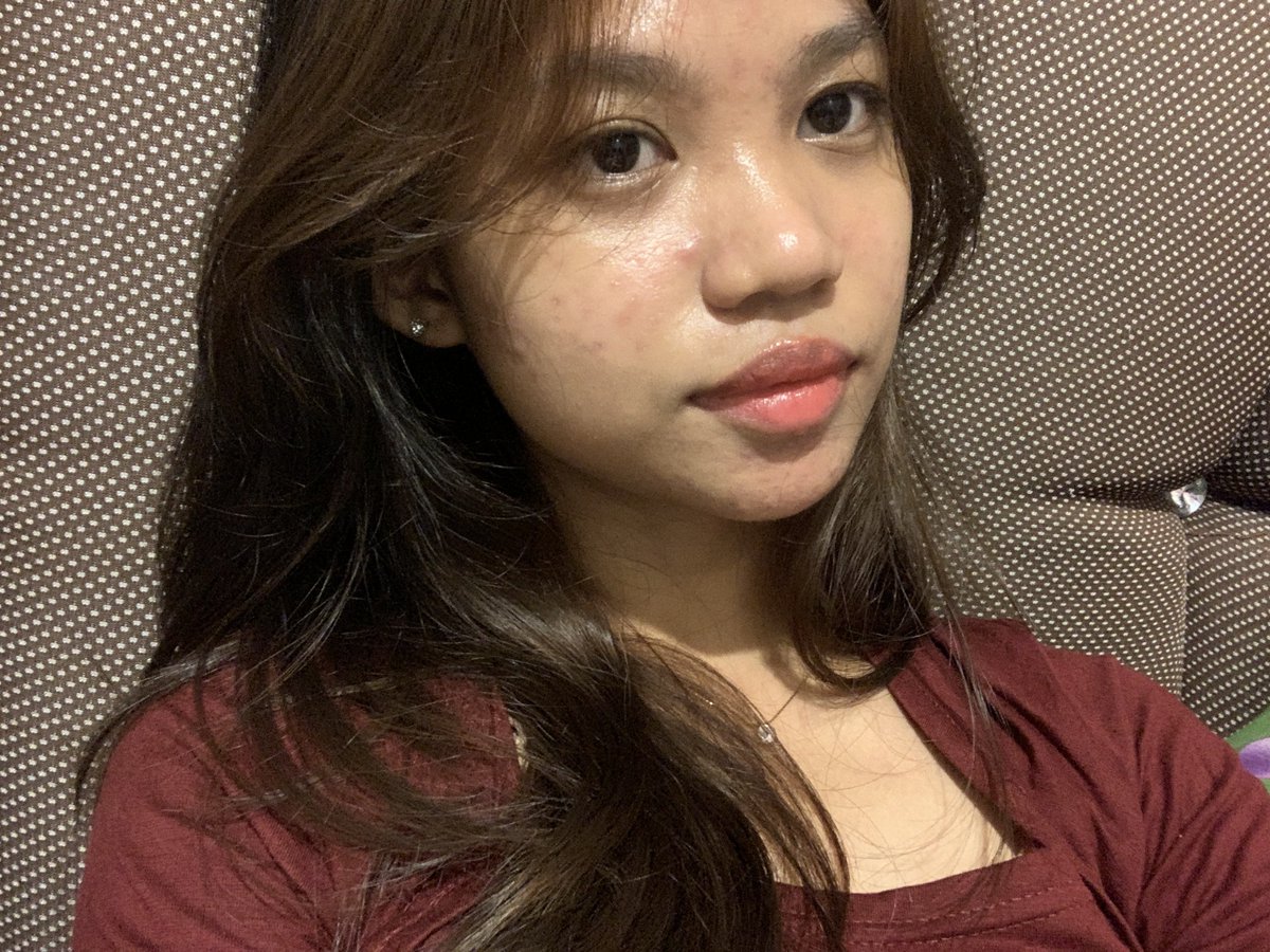 itsayeay's tweet photo. mau sharing ⚠️ acne journey &amp; honest review product yg ku pakai

‼️no endorse &amp; not affiliate ❌

skin type > oily MAMPUS acne prone, kusam😵‍💫

before juni 2024 &amp; after desember 2024 

(HAMPIR semua foto di thread ini aku pakai makeup yah tp bukan yang fresh, udah oksidasi) https://t.co/UScePpnfBj