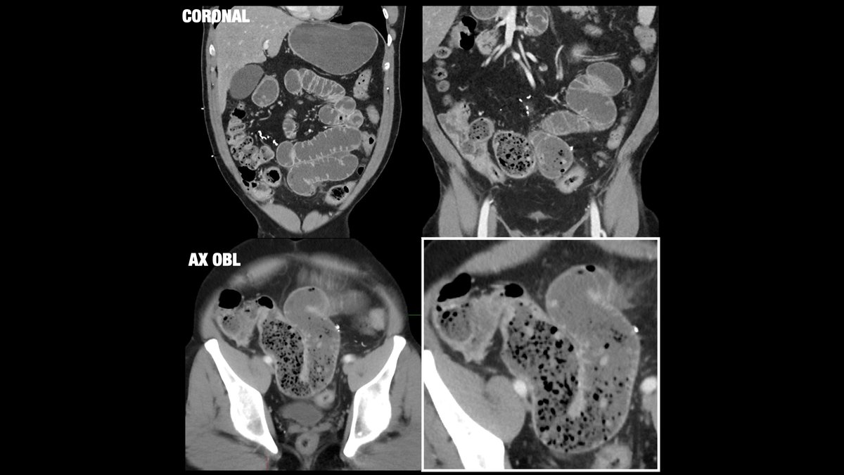 61-year-old male with history of prior appendectomy presenting with nausea/vomiting. Diagnosis? What is the name of this sign? <a href="/BrighamRad/">Brigham and Women's Radiology</a> <a href="/FOAMrad/">FOAMrad</a> <a href="/SAR_RFS/">SAR Resident and Fellow Section</a> <a href="/futureradres/">Future Radiology Residents</a> <a href="/CBRadiologia/">CBR</a> #MedEd