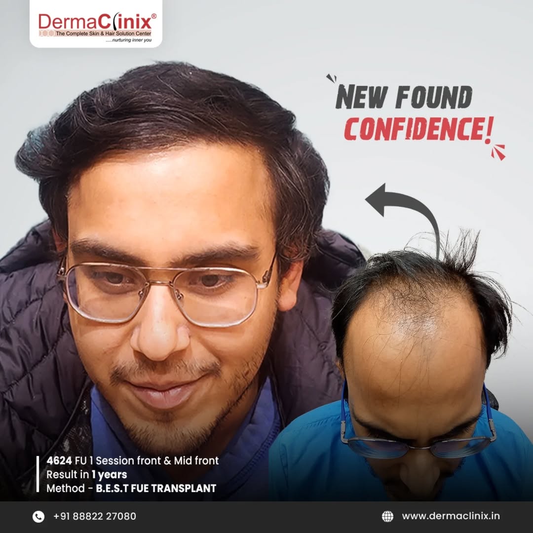 dr_kavish's tweet photo. The smile says it all...🤗🤗
✨ Jatin re-found his confidence ✨

Experienced a life changing transformation with his incredible 1-year result following a B.E.S.T. FUE hair transplant!

Call / WhatsApp on +918882227080

For more, visit: https://t.co/fE8Nj139nS

#DermaClinix #FUE https://t.co/Cn7SbbcxW0