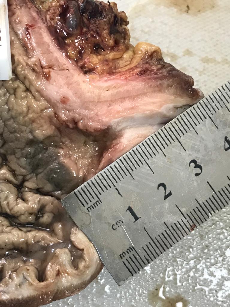 AfgPath's tweet photo. Ulcerative gastric mass. Adenocarcinoma https://t.co/WeczLTE1wp