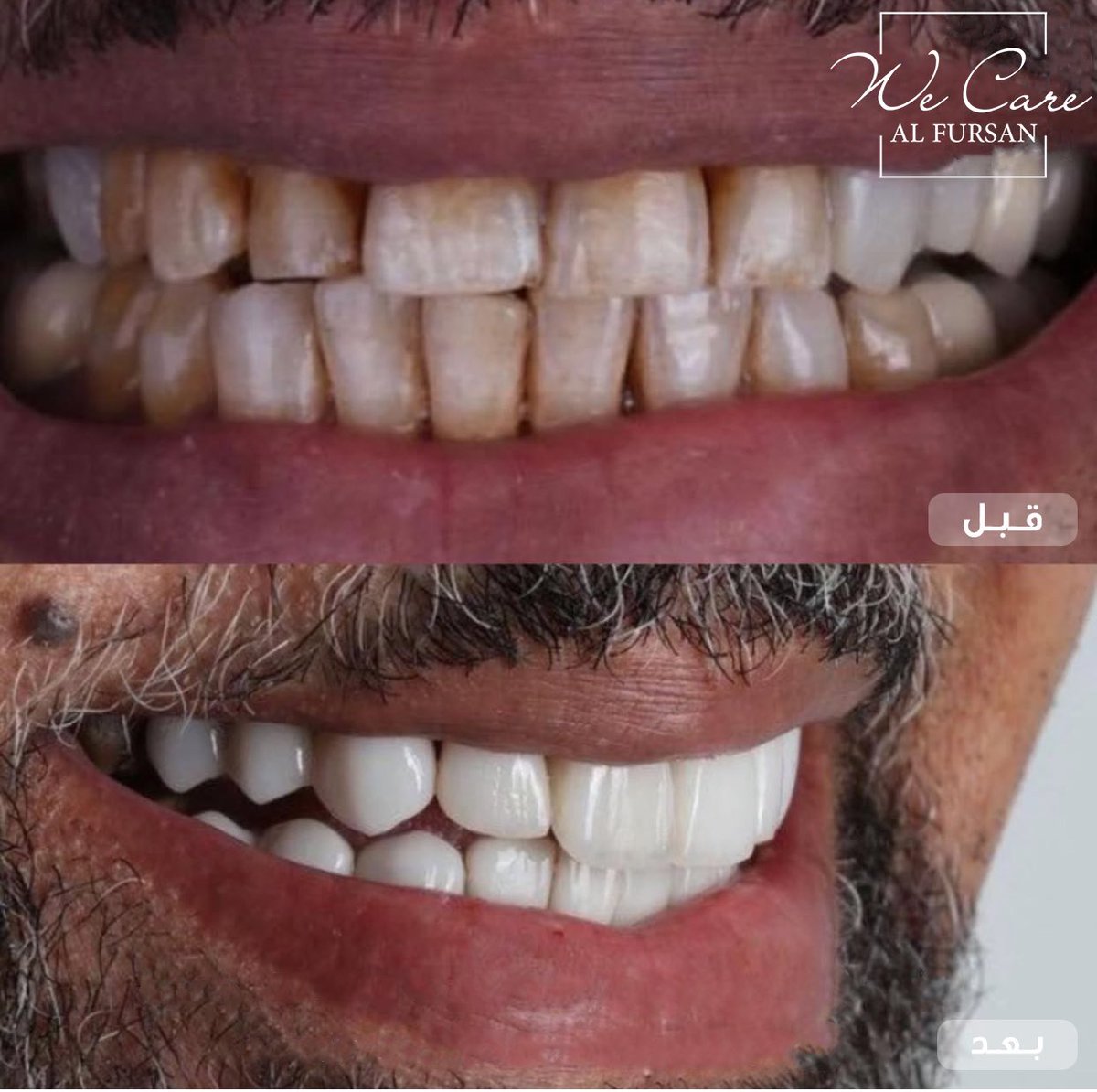 ابتسامات مراجعينا تفوز باجمل ابتسامات 😍😍
سعادتنا لما يطلع العميل راضي عن ابتسامته الجديدة
احجز موعدك وضبط اسنانك مع فريق من افضل اطباء علاج وتجميل الاسنان
للمواعيد:
0535019888
الرياض/ حي الملك سلمان "الواحه سابقاً"