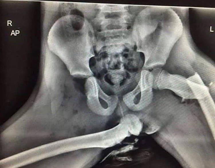 This is why you should never rest your legs on a car's dashboard.