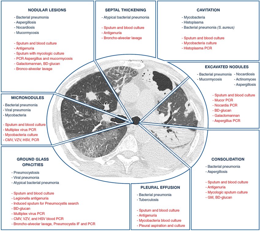 drsthanus's tweet image. Very useful!

Etiologies of pulmonary infections according to CT-scan patterns

link.springer.com/article/10.100…
